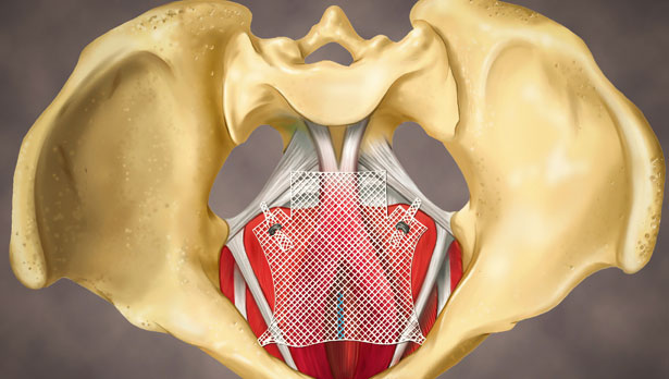 Why is bladder suspension surgery performed?