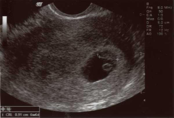 ultrasound