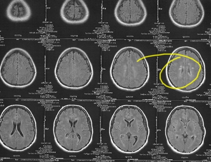 brain stem definition brain stem definition